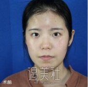 成都西区医院自体脂肪填充怎么样？有案例吗？ width=