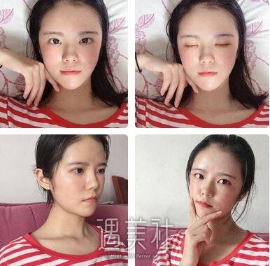 成都,自体脂肪填充