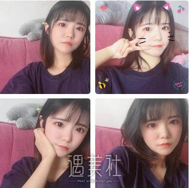 成都,自体脂肪填充