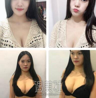 李发成,脂肪隆胸
