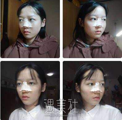北京,李沁奕,隆鼻