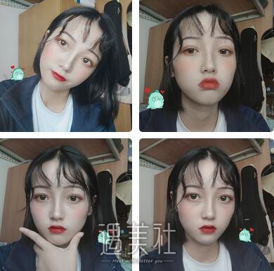 北京李沁奕隆鼻案例 术后两个月真实经历分享 width=