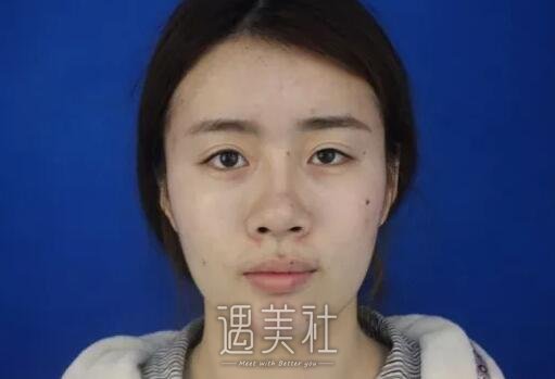 黄石中爱整形医院做双眼皮怎么样?有真实的案例吗?