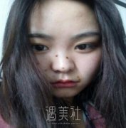 广州军区总医院整形科去痣果好吗?有真实案例吗? width=