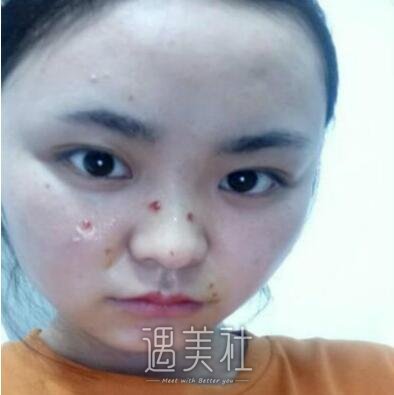 广州军区总医院整形科去痣果好吗?有真实案例吗?
