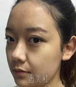 重庆永川蝶姿医院除皱技术如何?有相关的案例吗? width=