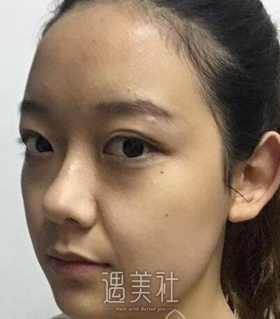 重庆永川蝶姿医院除皱技术如何?有相关的案例吗?