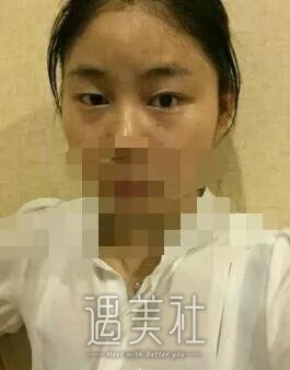 天津美莱卜胜利案例一览|双眼皮技术是真的好!