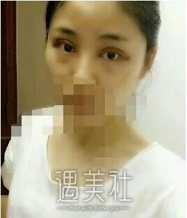 天津美莱卜胜利案例一览|双眼皮技术是真的好!