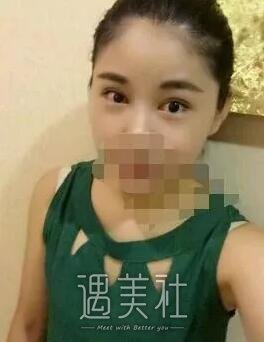 天津美莱卜胜利案例一览|双眼皮技术是真的好!