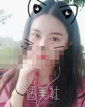 天津美莱卜胜利案例一览|双眼皮技术是真的好!