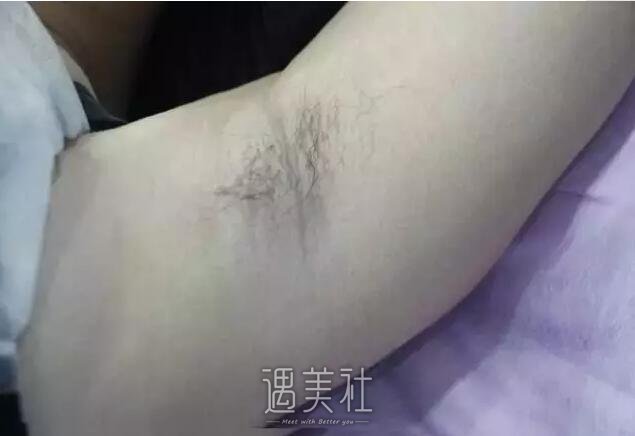 昆山百达丽整形医院脱毛案例分享，致摆脱腋毛的我!