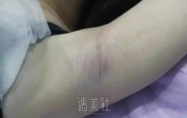 昆山百达丽整形医院脱毛案例分享，致摆脱腋毛的我!
