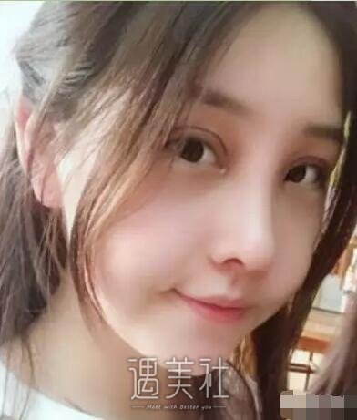 芜湖壹加壹医院双眼皮+开眼角案例分享，快来围观!