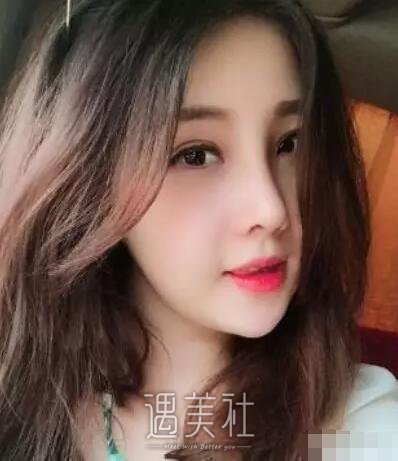 芜湖壹加壹医院双眼皮+开眼角案例分享，快来围观!