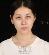 芜湖壹加壹医院双眼皮+开眼角案例分享，快来围观! width=