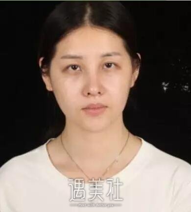 芜湖壹加壹医院双眼皮+开眼角案例分享，快来围观!