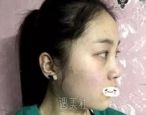 蚌埠市三院隆鼻案例展示，原来可以变化这么大!