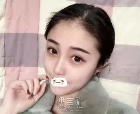 蚌埠市三院隆鼻案例展示，原来可以变化这么大!