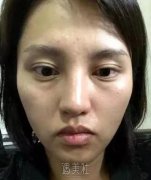 玉溪左医生脂肪填充技术好吗?能让我面部丰盈起来吗? width=