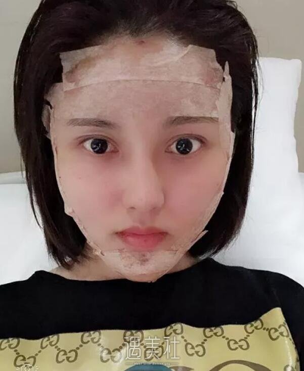 玉溪左医生脂肪填充技术好吗?能让我面部丰盈起来吗?