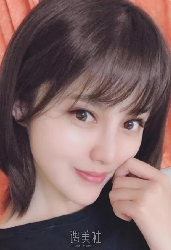 玉溪左医生脂肪填充技术好吗?能让我面部丰盈起来吗?