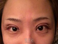 通化吴学军整形医院价格表：双眼皮案例真实分享~ width=