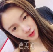 九院刘菲双眼皮案例：这个双眼皮我爱了！ width=