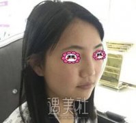 上海九院王健隆鼻案例分享，附恢复过程图~ width=