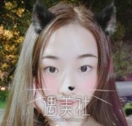 西美整形双眼皮怎么样？案例？ width=