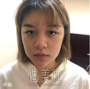 上海,缩小鼻翼
