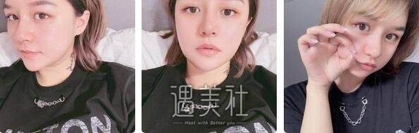 上海,缩小鼻翼