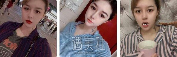 上海,缩小鼻翼