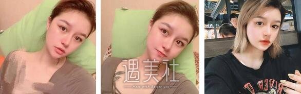 上海,缩小鼻翼