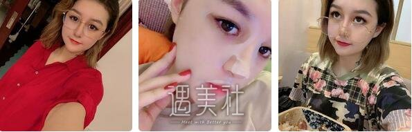 上海,缩小鼻翼