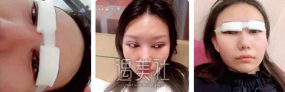 武汉,美基元,项利娇,割双眼皮