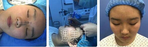南京,美贝尔,黄名斗,隆鼻