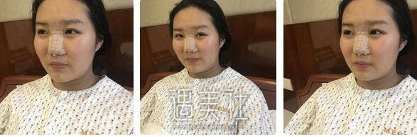 南京,美贝尔,黄名斗,隆鼻