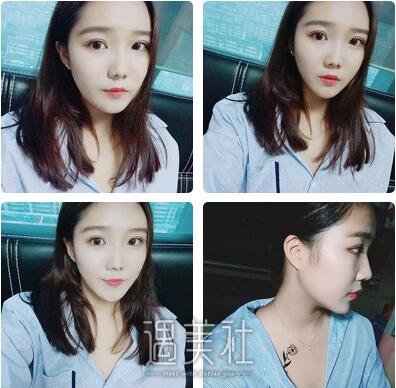南京,美贝尔,黄名斗,隆鼻