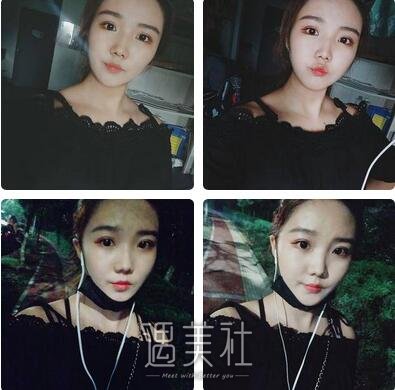 南京美贝尔医院黄名斗隆鼻案例~ width=