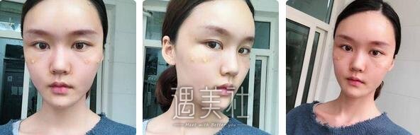 北京,冯斌,脂肪填充