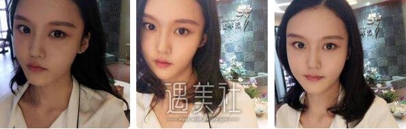 北京,冯斌,脂肪填充