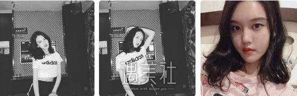 北京,冯斌,脂肪填充