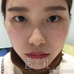 淄博中心医院割双眼皮怎么样?有真实案例吗?