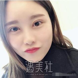 淄博中心医院割双眼皮怎么样?有真实案例吗?