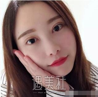 淄博中心医院割双眼皮怎么样?有真实案例吗?