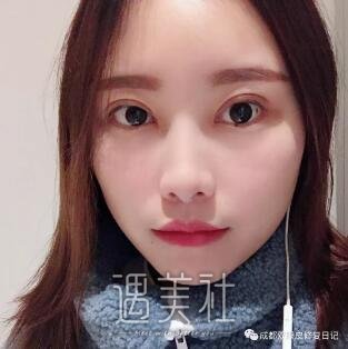 淄博中心医院割双眼皮怎么样?有真实案例吗?