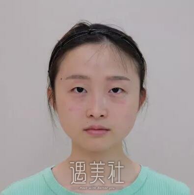 山大二院整形科双眼皮怎么样?亲身经历为你解答!