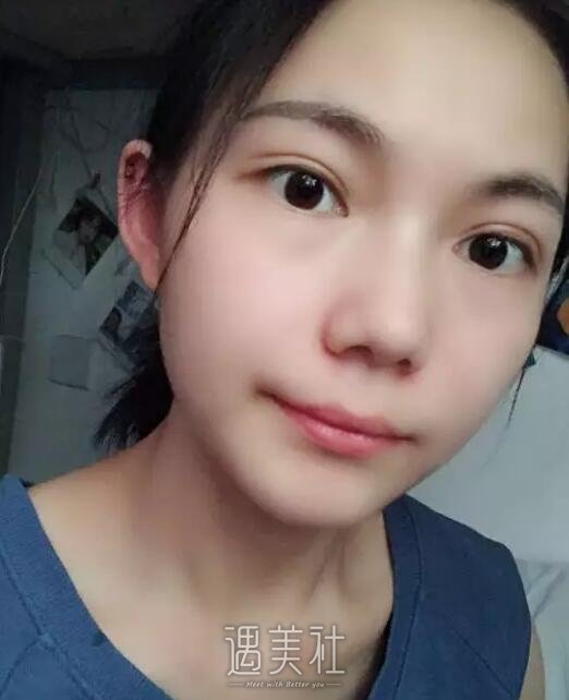 沧州京美做双眼皮好吗?做完整个人气质都变了!