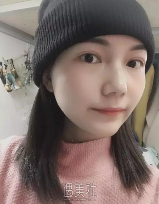 沧州京美做双眼皮好吗?做完整个人气质都变了!